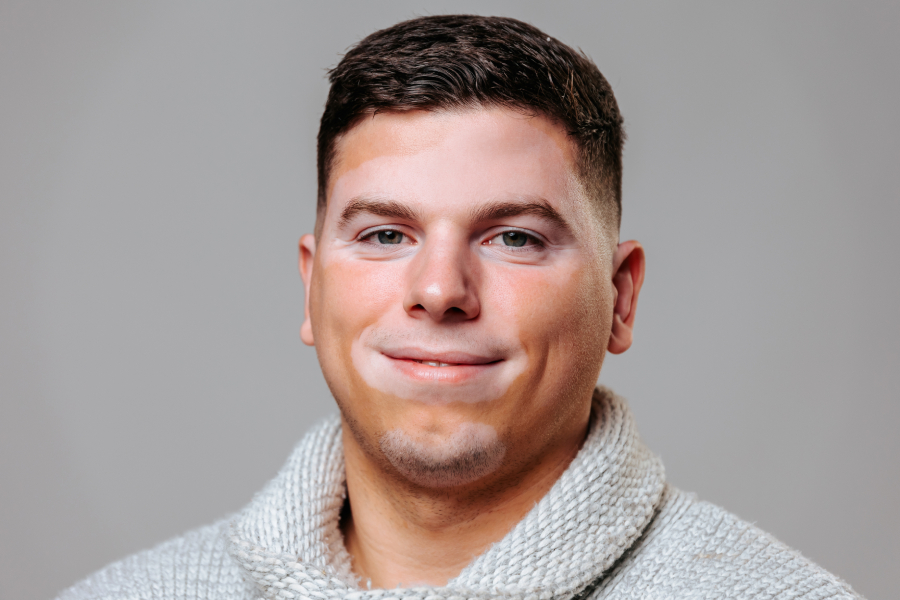 Витилиго — симптомы, диагностика, лечение * Клиника Диана в Санкт ...